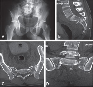 Caso clínico n.° 2. A: Radiografía AP de pelvis donde se observa una ligera elevación de la hemipelvis derecha a nivel de la articulación sacroiliaca. B-D: TAC de pelvis que evidencia la fractura de sacro con disociación lumbopélvica y estallido de S2.