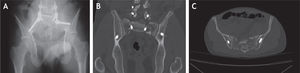 Caso clínico n.° 2. Radiografía AP (A) y TAC con ventana ósea coronal (B) y axial (C) de pelvis donde se observa la disposición de los tornillos lumbopélvicos, que se encuentran por dentro de los iliacos
