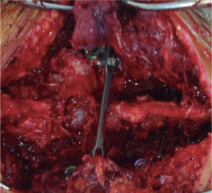 Caso clínico n.° 2. Imagen intraoperatoria, que muestra la barra transversa DTT y, a la izquierda de ella, el sitio de la laminectomía descompresiva