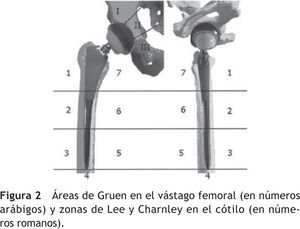 Áreas de Gruen en el vástago femoral (en números arábigos) y zonas de Lee y Charnley en el cótilo (en números romanos).