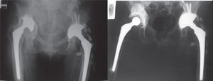 Imagen del resultado de la revisión con la técnica de injerto óseo impactado en uno de los pacientes, en quien se logró una reconstrucción adecuada para el implante de los nuevos componentes.