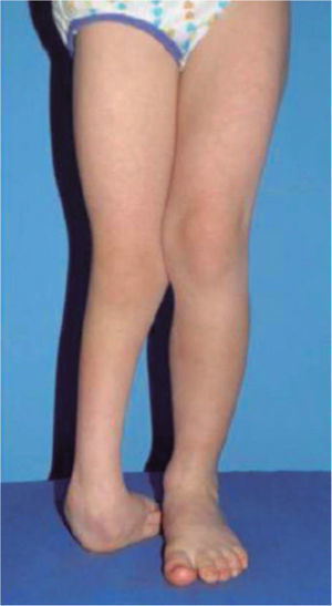 Paciente en posición bípeda. Nótese el acortamiento de la extremidad derecha, la oblicuidad pélvica, la deformidad angular de la rodilla y la deformidad del pie.
