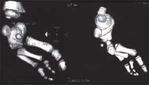 Tomografía del pie derecho. Nótese las deformidades de desarrollo de los huesos del tarso. Se observa una posible coalición entre el primordio del astrágalo y el calcáneo.