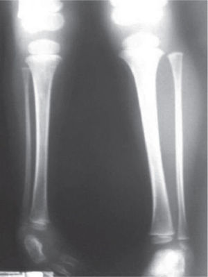 Radiografías de piernas comparativas. Nótese la hipoplasia del peroné derecho.
