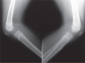 Radiografías laterales de las rodillas. Nótese el acortamiento proximal del peroné derecho.