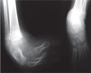 Radiografías de pies comparativos. Nótese las deformidades del pie derecho y la hipoplasia severa del astrágalo con ausencia del cuarto y quinto rayos.