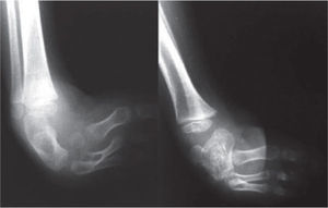Radiografías del pie derecho. Nótese la hipoplasia del astrágalo y la consecuente pérdida de la relación articular del tobillo.
