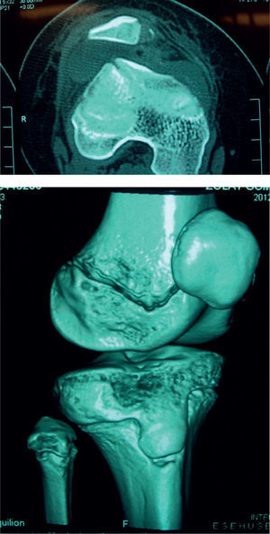 Tomografía computarizada de rodilla. Se evidencia un fragmento grande parapatelar medial y un fragmento en la escotadura patelar del fémur, además de una subluxación lateral de la rótula.