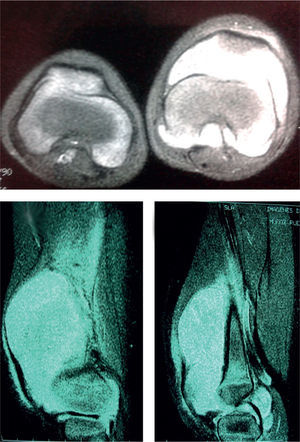 La resonancia magnética muestra lesión quística en la bursa suprapatelar que afecta a la articulación patelofemoral y femorotibial, no infiltrante a estructuras óseas o de tejidos blandos. El radiólogo informa de sarcoma sinovial, sinovitis y condromatosis de la rodilla.