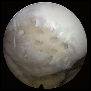 Lesión condral grado IV extensa de la faceta externa de la patela, a la cual se ha realizado espongialización.