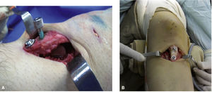 A: Anteriorización con injerto y osteosíntesis con tornillos. B: Efecto de medialización para centramiento rotuliano.