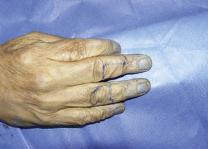 Marcación del colgajo gemelo axial en dedos de cadáver. Vista superior.