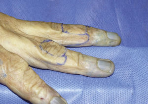 Marcación del colgajo gemelo axial en dedos de cadáver. Vista lateral.