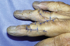 Transposición de colgajo gemelo axial en tercer y cuarto dedos mano derecha de cadáver. Vista lateral.