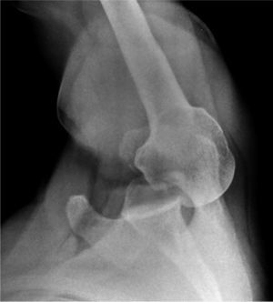 Radiografía axilar que muestra luxación glenohumeral posterior del hombro derecho.