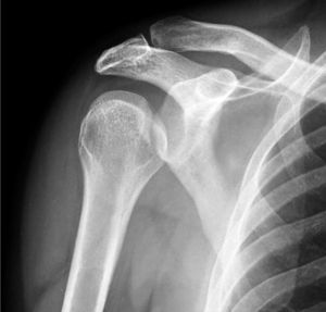Radiografía anteroposterior de hombro previa a la reducción de la luxación; se observa una lesión tipo Hill-Sachs inversa.