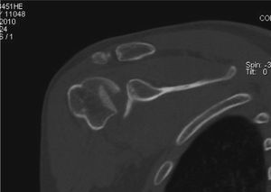 Imagen de corte axial de tomografía computarizada de hombro derecho; lesión tipo Hill-Sachs inversa luego de la reducción cerrada de la luxación.