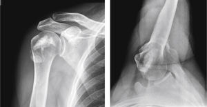 Radiografías anteroposterior y axilar de hombro en el posquirúrgico inmediato; se evidencia la adecuada reducción de la fractura y la presencia de cemento con fosfato de calcio en el defecto subcondral.