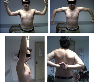 Fotografías del paciente 4 meses después de la cirugía; se observa la adecuada recuperación de los arcos de movilidad del hombro lesionado (derecho).