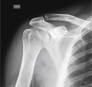 Radiografía anteroposterior de hombro 2 años después de la cirugía; evidencia radiológica de la adecuada consolidación de la fractura, con reabsorción parcial del cemento óseo. Nótese la restauración de la esfericidad de la cabeza humeral.