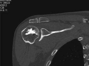 Imagen de corte axial de tomografía computarizada de hombro derecho tomada 2 años después de la cirugía; se ve la adecuada reducción y la consolidación de la fractura, con reabsorción parcial del cemento óseo.