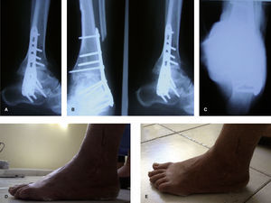 A-C: Radiografías en proyecciones lateral de tobillo, anteroposterior de tobillo y de Saltzman. D y E: Resultado postoperatorio, pie plantígrado.