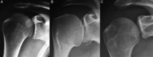 Radiografía de hombro anteroposterior. A: Normal. B: Fractura con avulsión del borde glenoideo inferior. C: Remodelación del borde glenoideo inferior. Imagen tomada de Boileau et al.8.