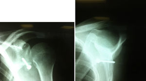 Radiografías posoperatorias.