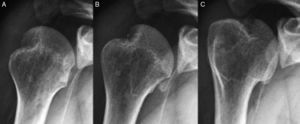 Lesión de Hill-Sachs en la radiografía anteroposterior de hombro en las tres rotaciones. A: Rotación neutra. B: Rotación interna. C: Rotación externa. Imagen tomada de Boileau et al.8.