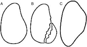 Tipos de lesión ósea glenoidea. A: Estado normal de la glenoides. B: Fractura del reborde anterior e inferior glenoideo. C: Lesión ósea remodelada. Imagen tomada de Lo et al.11.