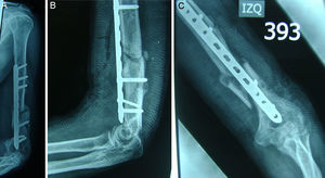 Radiografías del posoperatorio inmediato que muestran la adecuada posición del material de osteosíntesis.
