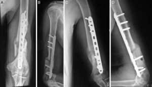 A y B: Radiografías a las 6 semanas del posoperatorio. C y D: Radiografías a las 18 semanas del posoperatorio, con signos de consolidación de la fractura.