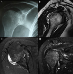Imágenes diagnósticas del hombro derecho. A: Radiografía con cambios artrósicos. B, C y D: Resonancia con imagen sugestiva de cuerpos libres intraarticulares y cambios óseos en la cabeza humeral y la glenoides.
