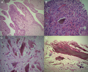 Imágenes histológicas. A: Proliferación papilar sinovial. B y C: Hiperplasia e hipertrofia de sinoviocitos con depósito de AH. D: Tendón del bíceps con depósito de AH.