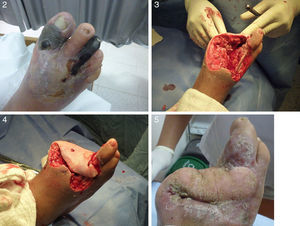 Formas de tratamiento quirúrgico del pie diabético y resultados.