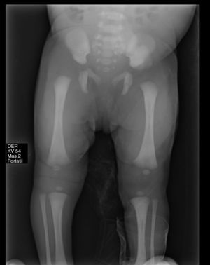 Luxacion de rodilla con subluxacion de cadera ipsilate.