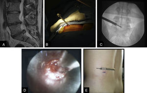 Nucleotomía endoscópica. A) Hernia discal L5-S1. B y C) Introducción de la cánula de trabajo. D) Imagen endoscópica de la hernia discal. Imagen de la herida en el postoperatorio inmediato.