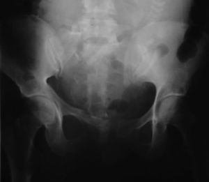 Radiografía anteroposterior de la pelvis.