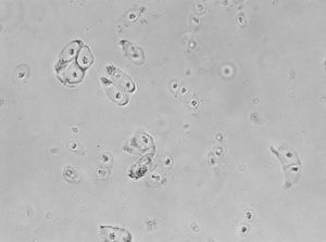 Cultivo de condrocitos humanos obtenidos de cartílago articular de rodilla mediante biopsia por artroscopia (microscopia de campo claro, 200X).