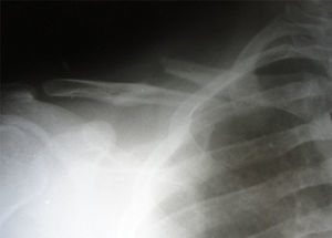 Radiografía preoperatoria que muestra fractura desplazada de clavícula con acortamiento mayor de 2 cm.