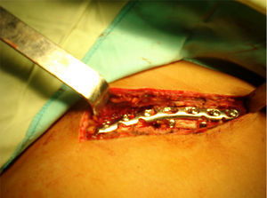 Fotografía intraoperatoria de intervención quirúrgica. Reducción abierta más osteosíntesis de fractura multifragmentaria de la clavícula.