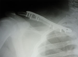Radiografía postoperatoria de la reducción abierta más osteosíntesis con placa anatómica LCP. Se simplifica la fractura mediante la colocación de tornillos de compresión interfragmentaria.