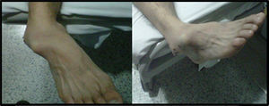 Fotografías clínicas de la deformidad del pie derecho en el momento del ingreso en el servicio de urgencias.