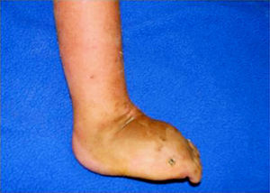 Vista postoperatoria del pie en que se aprecia obtención de un pie plantígrado sin complicaciones con la cicatriz.