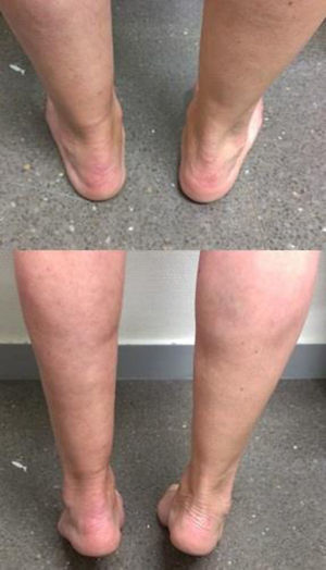 Fotos clínicas en bipedestación y de puntillas a los 5 meses de la lesión.