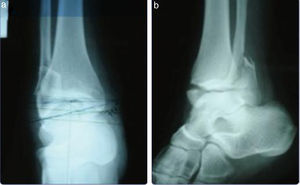 Radiografía anteroposterior y lateral de fractura Weber b (tomada de Holguín E, Herrera J, Reyes O, Mesa J. Resultados funcionales de la técnica de placa antideslizante versus técnica de placa lateral para el tratamiento quirúrgico de fractura del maléolo externo de tipo Weber B. Rev Col Or Tra. 2008;22:117-21).