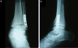 Radiografía anteroposterior y lateral de osteosíntesis con placa antideslizante (tomada de Holguín E, Herrera J, Reyes O, Mesa J. Resultados funcionales de la técnica de placa antideslizante versus técnica de placa lateral para el tratamiento quirúrgico de fractura del maléolo externo tipo Weber B. Rev Col Or Tra. 2008;22:117-21).