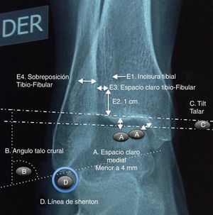 Medición de los valores radiográficos normales (tomada de Peláez L, Reina E, Herrera JM. Luxofracturas de tobillo. Rev Latinoam Ortop Traumat. 2014;3:61-78).