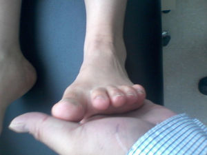 Estimulación plantar (tomada de Peláez L, Reina E, Herrera JM. Luxofracturas de tobillo. Rev Latinoam Ortop Traumat. 2014;3:61-78).