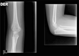 Radiografía de codo AP y lateral a los 14 meses tras la cirugía.